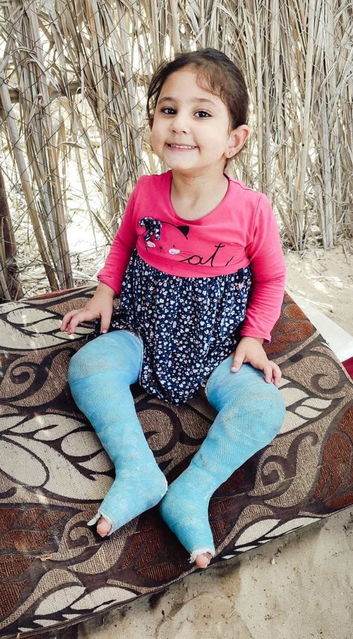 Minah, a 3-year-old with clubfoot, was casted in October 2024 after an orthopedic surgeon’s visit to Gaza. The casting, which usually requires several changes, was aimed to gradually correct the position of her feet. 