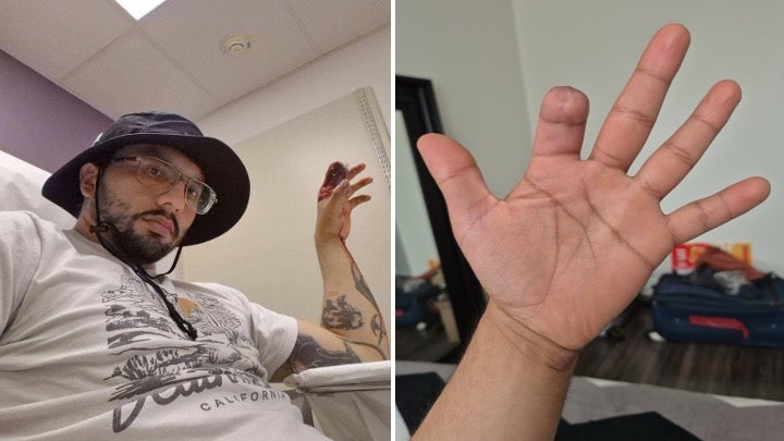 A sheriff’s deputy fired a flash-bang device that exploded upon impact on protester Sergio Espejo’s hand, resulting in the amputation of his left index finger, in downtown Los Angeles on June 14, 2025. 