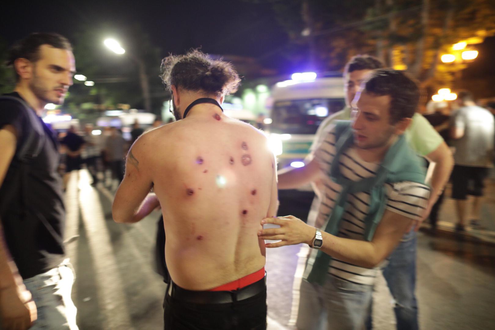 Guram Muradov, Civil.ge journalist sustained multiple impacts from police-fired rubber bullets.