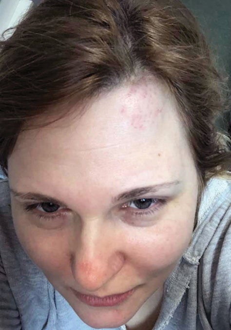 Journalist Elena Milashina, following an attack in Chechnya. 