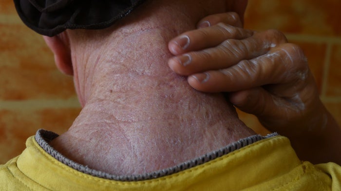 A man with albinism covers himself in sunscreen prepared by members of an NGO on August 18, 2016, in Abidjan, Côte d’Ivoire. 
