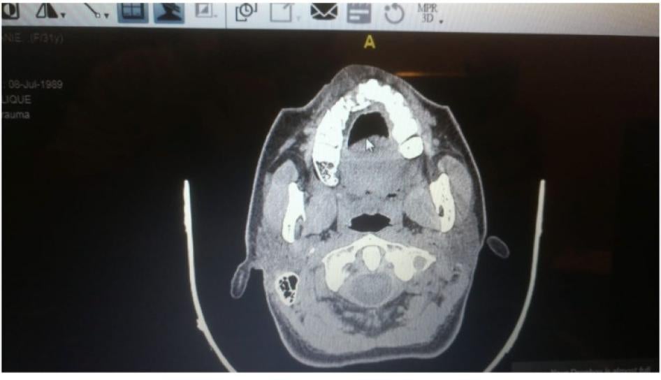 X-ray showing a fracture to a protesters’ maxillary bone after she was shot with a rubber ball. 
