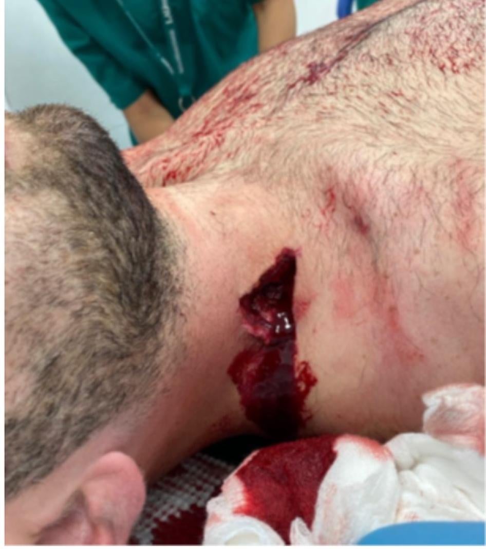 A kinetic impact projectile hit a protester in the neck.