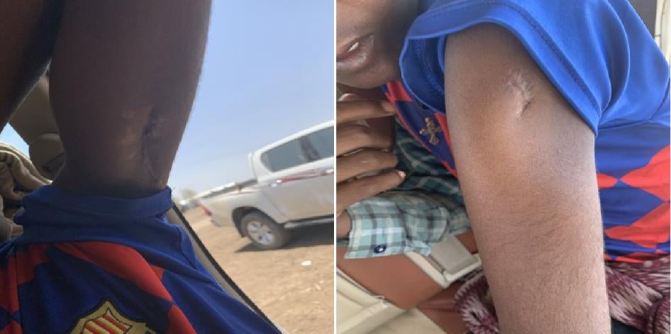 Two close up images of scars