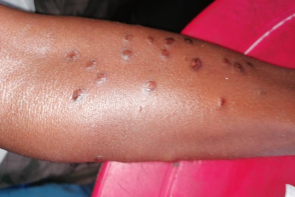 Un conducteur de moto yansi de 36 ans a été attaqué et blessé le 4 septembre par des assaillants Mobondo alors qu'il rentrait chez lui depuis le village de Bethanie. © 2022 Venance Kalenga/Human Rights Watch