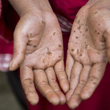 Hands of Selina Aktar, a woman in her late 30s with arsenic-related health conditions that first began appearing 20 years ago. 